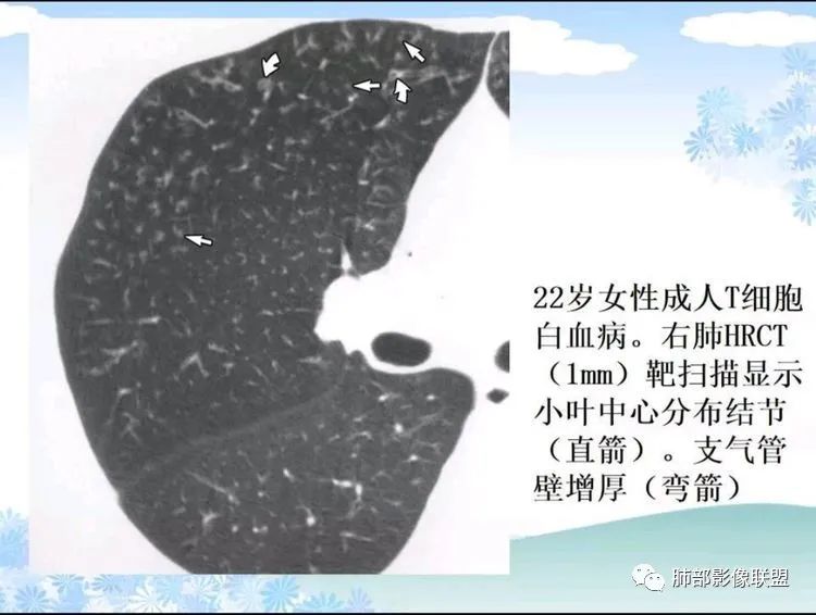 影像PPT - 【PPT】白血病肺部浸润CT诊断与鉴别-27
