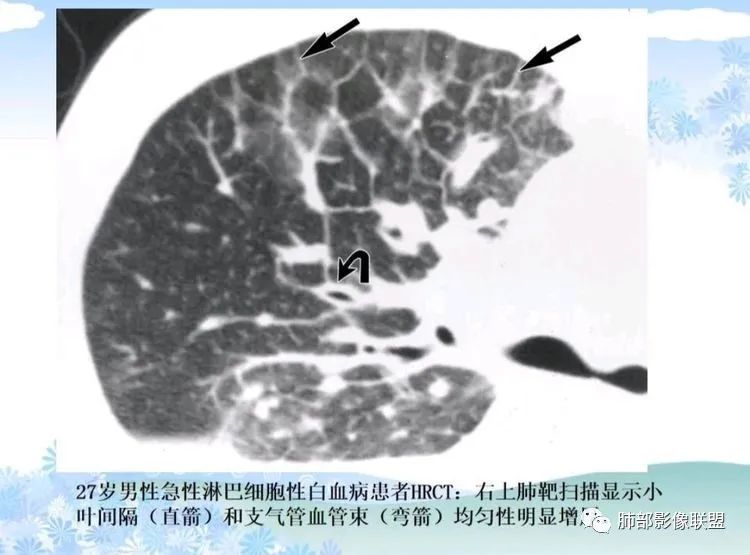 影像PPT - 【PPT】白血病肺部浸润CT诊断与鉴别-11