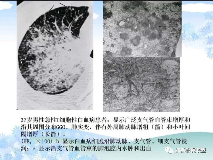 影像PPT - 【PPT】白血病肺部浸润CT诊断与鉴别-23