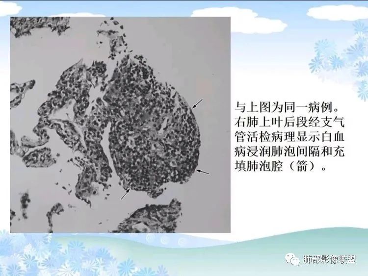 影像PPT - 【PPT】白血病肺部浸润CT诊断与鉴别-19
