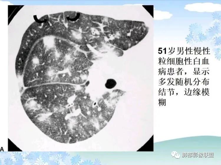 影像PPT - 【PPT】白血病肺部浸润CT诊断与鉴别-28