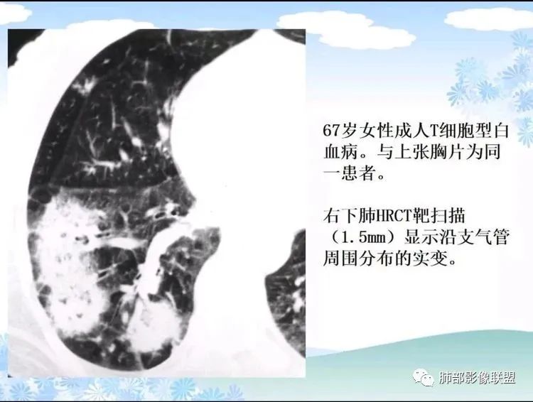 影像PPT - 【PPT】白血病肺部浸润CT诊断与鉴别-22