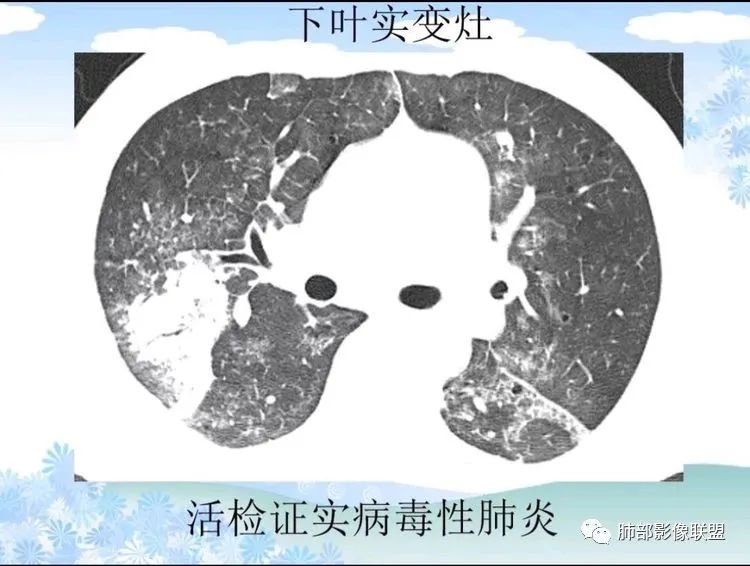 影像PPT - 【PPT】白血病肺部浸润CT诊断与鉴别-37