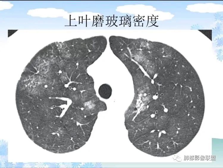 影像PPT - 【PPT】白血病肺部浸润CT诊断与鉴别-35