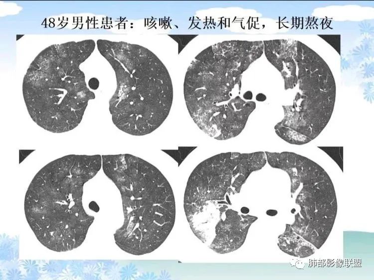 影像PPT - 【PPT】白血病肺部浸润CT诊断与鉴别-34