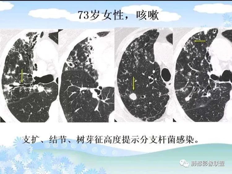 影像PPT - 【PPT】白血病肺部浸润CT诊断与鉴别-38