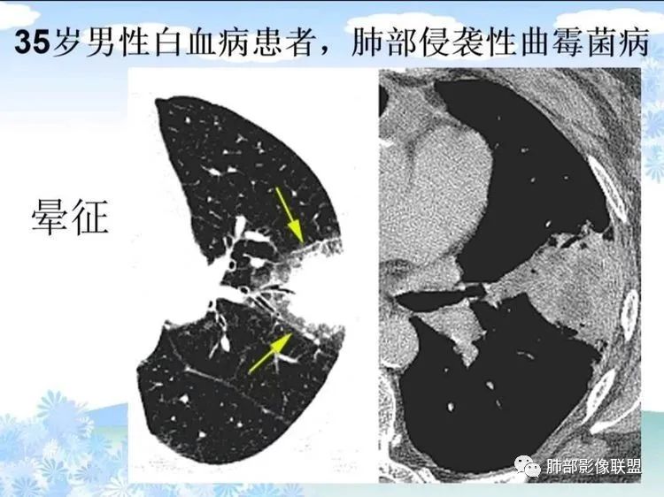 影像PPT - 【PPT】白血病肺部浸润CT诊断与鉴别-39