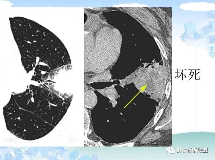 影像PPT - 【PPT】白血病肺部浸润CT诊断与鉴别-40