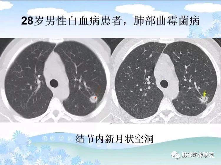 影像PPT - 【PPT】白血病肺部浸润CT诊断与鉴别-41