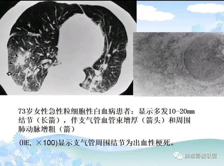 影像PPT - 【PPT】白血病肺部浸润CT诊断与鉴别-29
