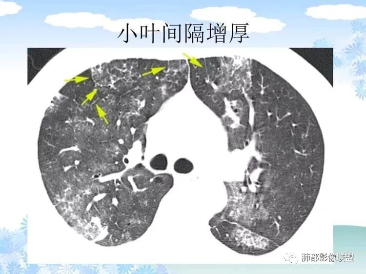 影像PPT - 【PPT】白血病肺部浸润CT诊断与鉴别-36