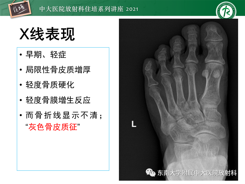 影像PPT - 【PPT】应力性骨折及与病理性骨折的鉴别诊断-7