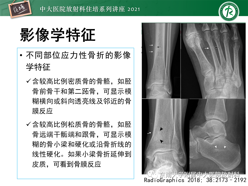 影像PPT - 【PPT】应力性骨折及与病理性骨折的鉴别诊断-12
