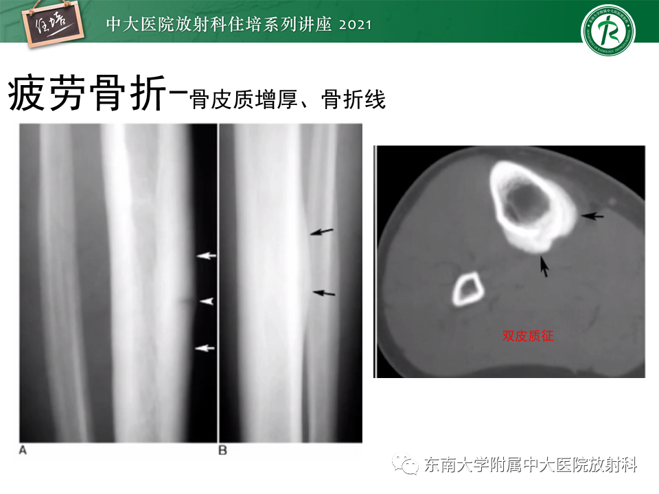 影像PPT - 【PPT】应力性骨折及与病理性骨折的鉴别诊断-10