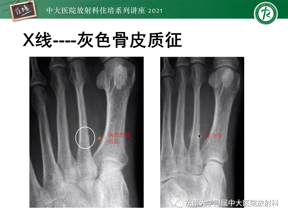 影像PPT - 【PPT】应力性骨折及与病理性骨折的鉴别诊断-8