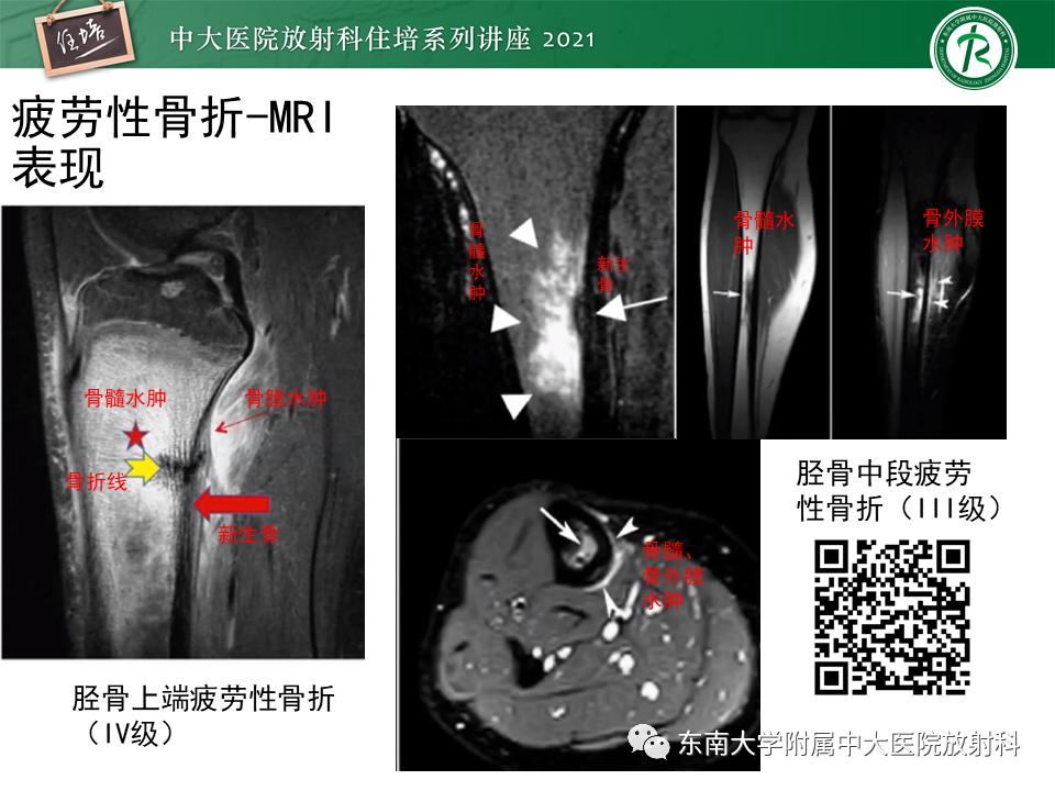 影像PPT - 【PPT】应力性骨折及与病理性骨折的鉴别诊断-14