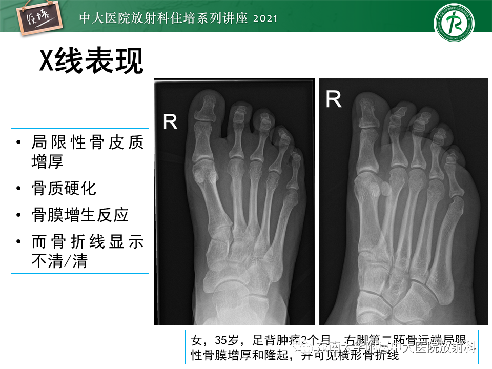 影像PPT - 【PPT】应力性骨折及与病理性骨折的鉴别诊断-9