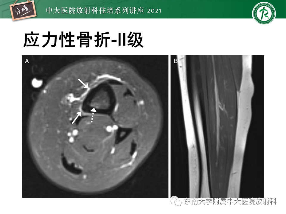 影像PPT - 【PPT】应力性骨折及与病理性骨折的鉴别诊断-16