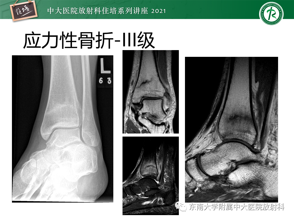 影像PPT - 【PPT】应力性骨折及与病理性骨折的鉴别诊断-17