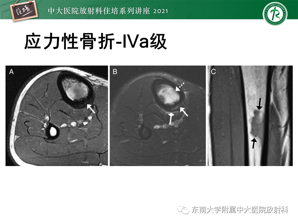 影像PPT - 【PPT】应力性骨折及与病理性骨折的鉴别诊断-18