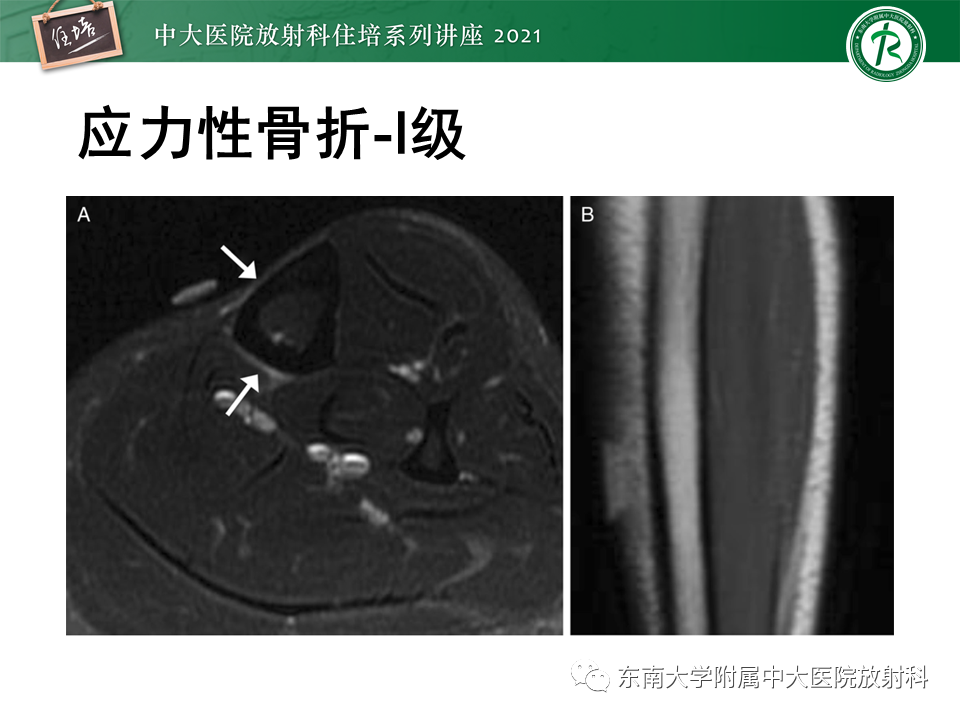 影像PPT - 【PPT】应力性骨折及与病理性骨折的鉴别诊断-15