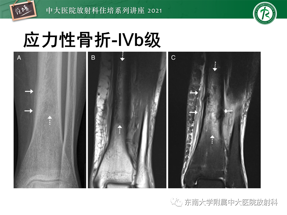 影像PPT - 【PPT】应力性骨折及与病理性骨折的鉴别诊断-19