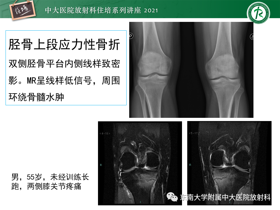 影像PPT - 【PPT】应力性骨折及与病理性骨折的鉴别诊断-20