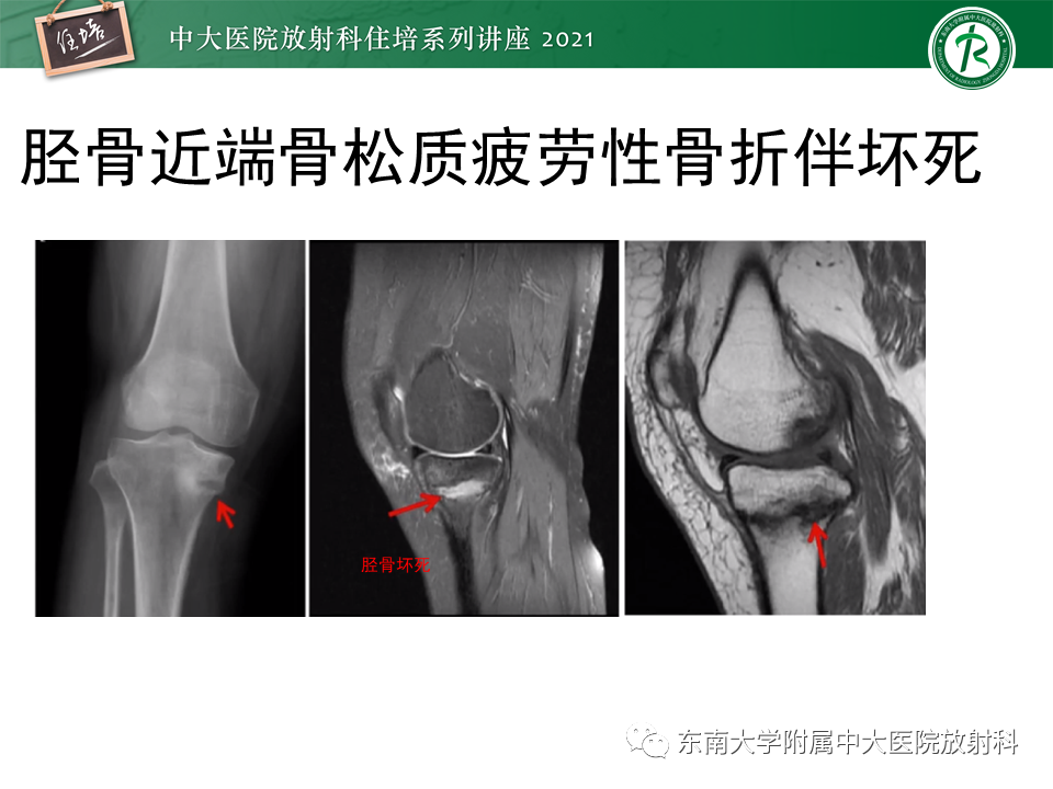 影像PPT - 【PPT】应力性骨折及与病理性骨折的鉴别诊断-21