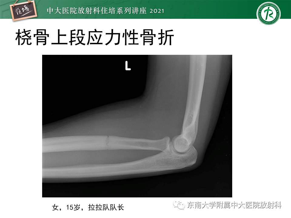 影像PPT - 【PPT】应力性骨折及与病理性骨折的鉴别诊断-22