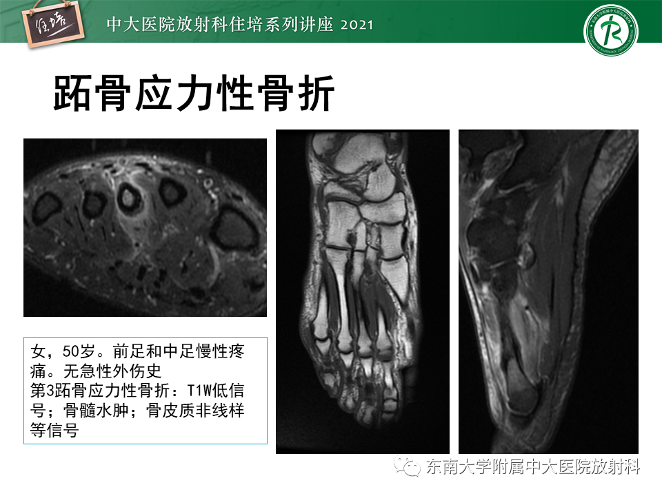影像PPT - 【PPT】应力性骨折及与病理性骨折的鉴别诊断-24