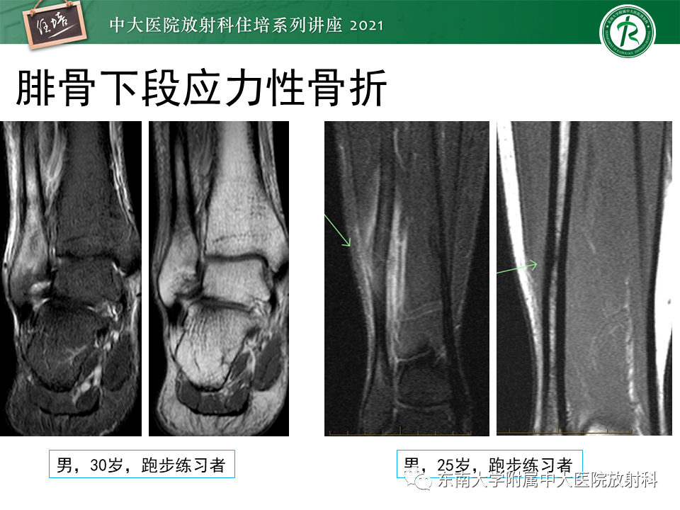 影像PPT - 【PPT】应力性骨折及与病理性骨折的鉴别诊断-23