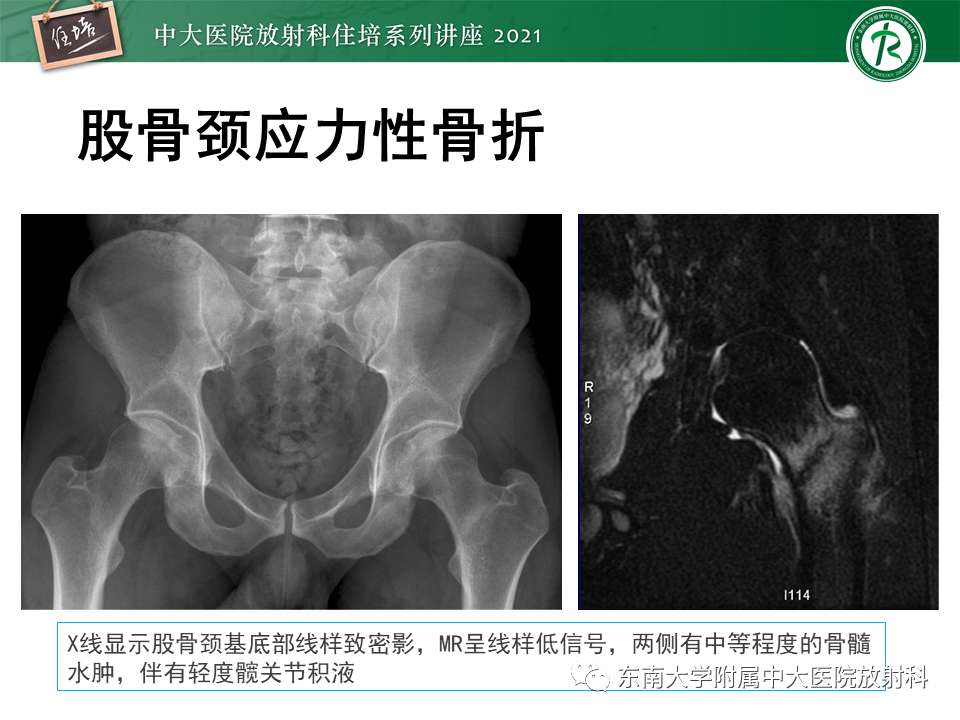 影像PPT - 【PPT】应力性骨折及与病理性骨折的鉴别诊断-25