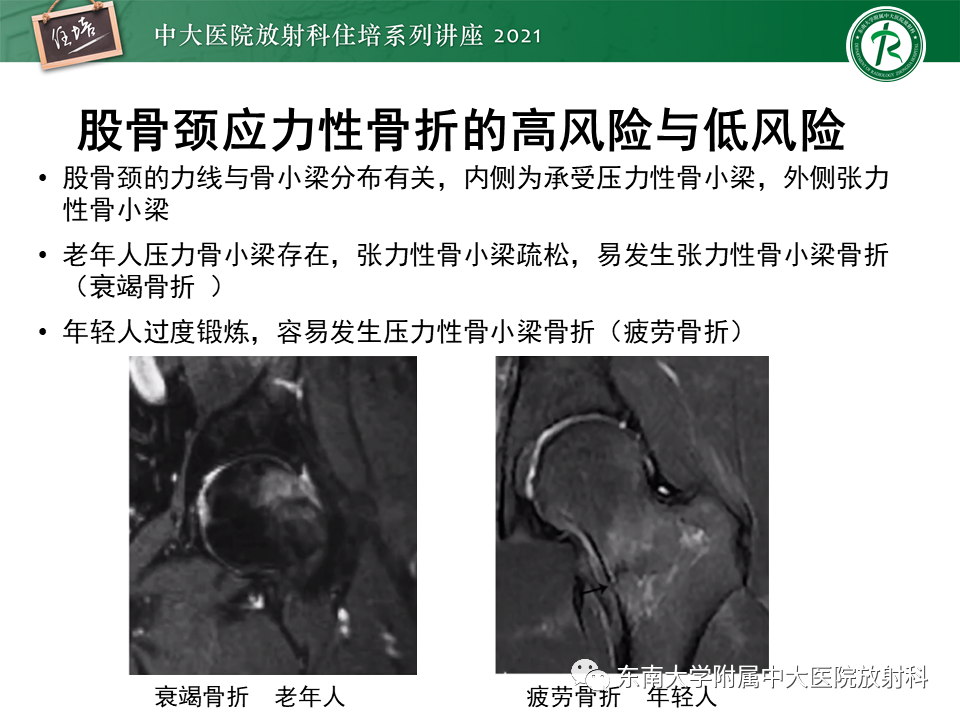 影像PPT - 【PPT】应力性骨折及与病理性骨折的鉴别诊断-28