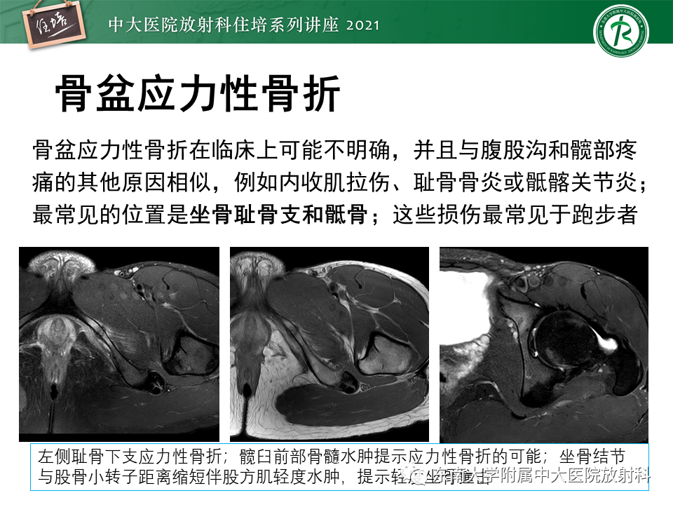 影像PPT - 【PPT】应力性骨折及与病理性骨折的鉴别诊断-29
