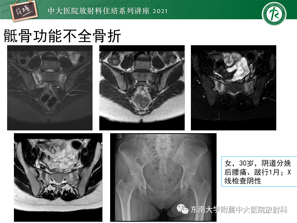 影像PPT - 【PPT】应力性骨折及与病理性骨折的鉴别诊断-30