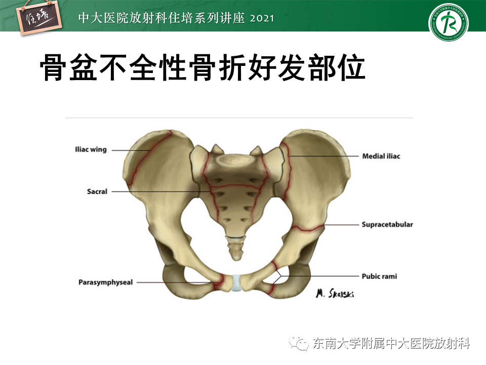 影像PPT - 【PPT】应力性骨折及与病理性骨折的鉴别诊断-31