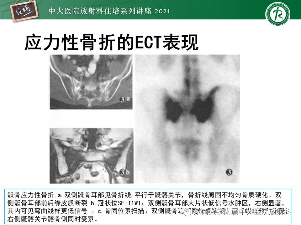 影像PPT - 【PPT】应力性骨折及与病理性骨折的鉴别诊断-34