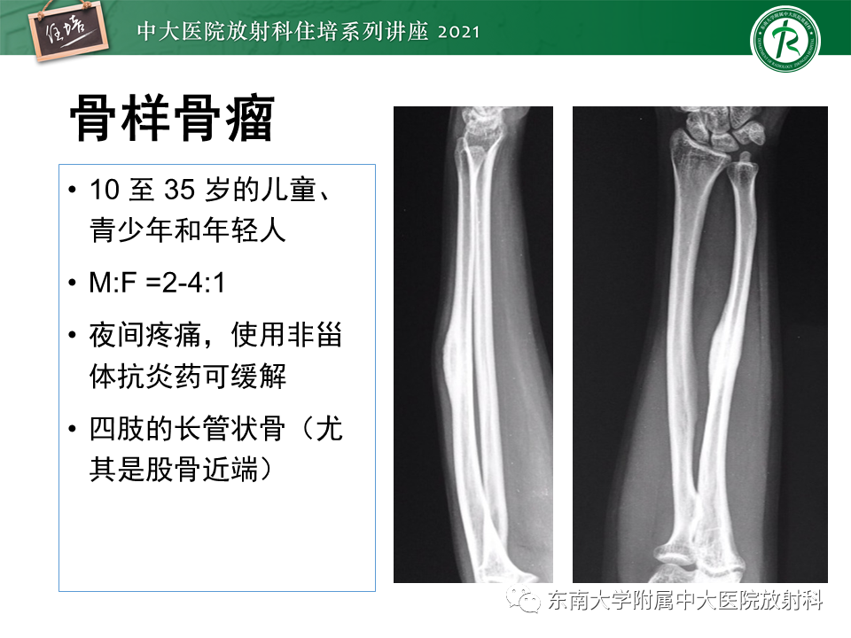 影像PPT - 【PPT】应力性骨折及与病理性骨折的鉴别诊断-36