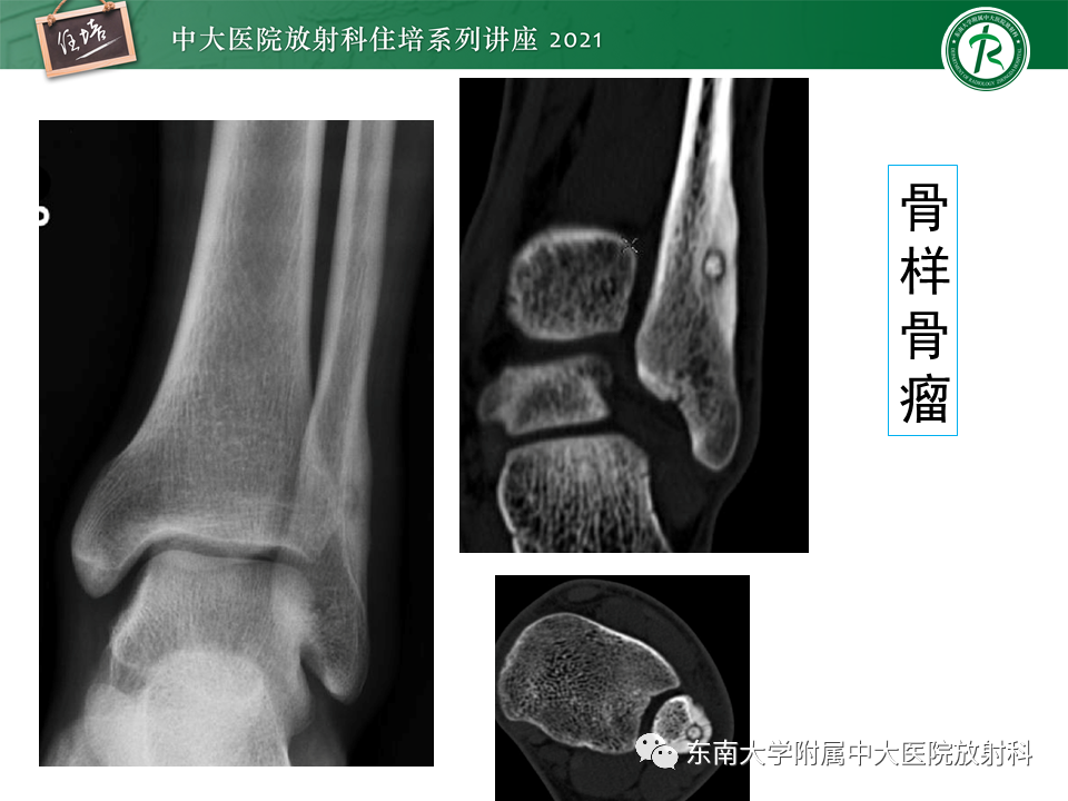 影像PPT - 【PPT】应力性骨折及与病理性骨折的鉴别诊断-37