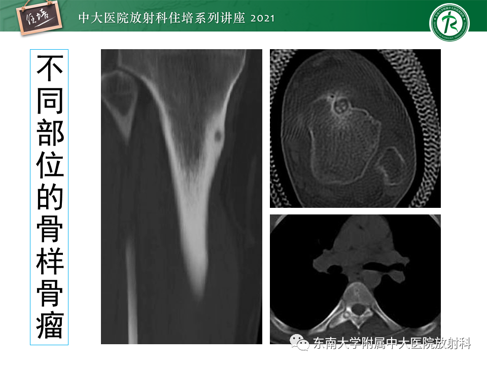 影像PPT - 【PPT】应力性骨折及与病理性骨折的鉴别诊断-38