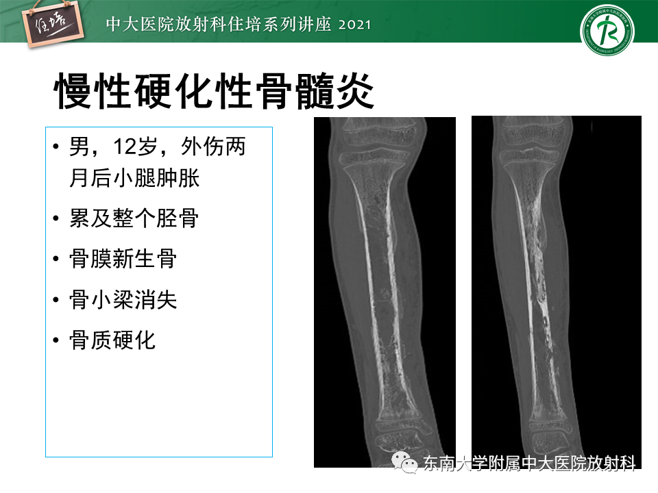 影像PPT - 【PPT】应力性骨折及与病理性骨折的鉴别诊断-39