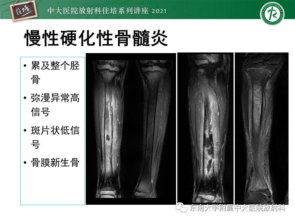 影像PPT - 【PPT】应力性骨折及与病理性骨折的鉴别诊断-40