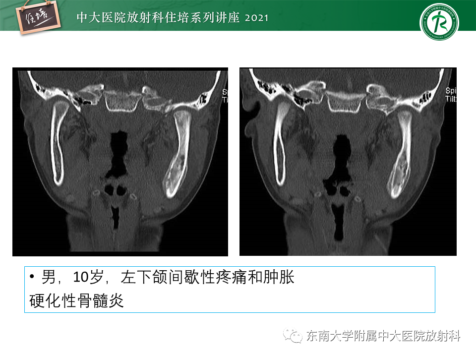 影像PPT - 【PPT】应力性骨折及与病理性骨折的鉴别诊断-41