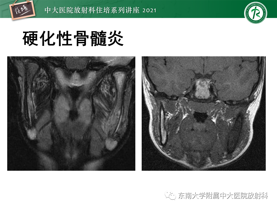 影像PPT - 【PPT】应力性骨折及与病理性骨折的鉴别诊断-42