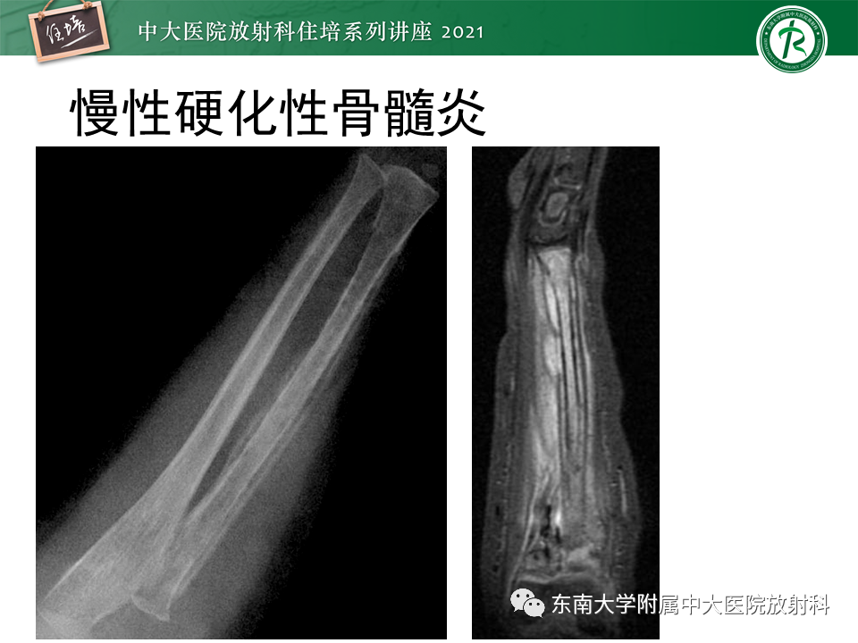影像PPT - 【PPT】应力性骨折及与病理性骨折的鉴别诊断-43