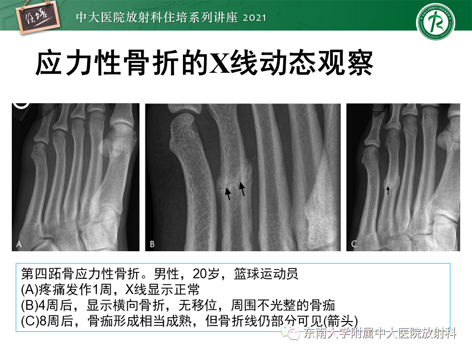 影像PPT - 【PPT】应力性骨折及与病理性骨折的鉴别诊断-44