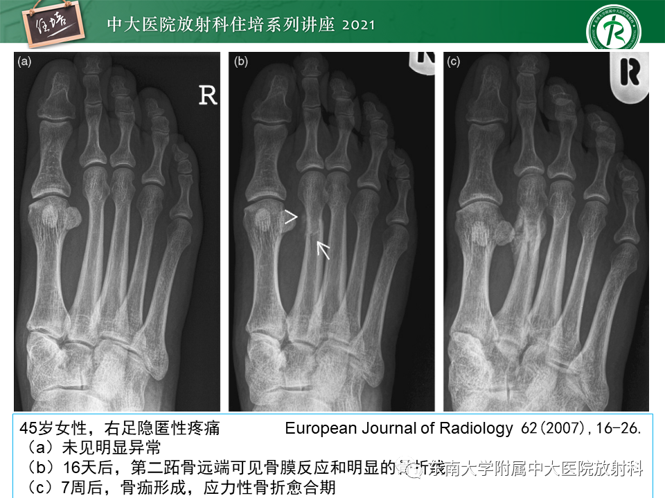 影像PPT - 【PPT】应力性骨折及与病理性骨折的鉴别诊断-45