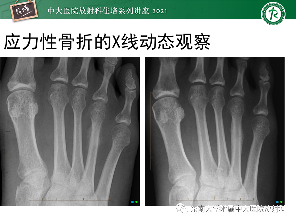 影像PPT - 【PPT】应力性骨折及与病理性骨折的鉴别诊断-46