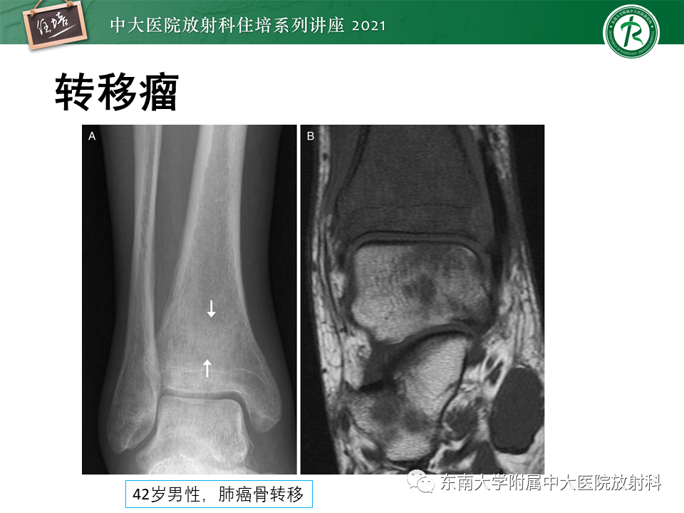 影像PPT - 【PPT】应力性骨折及与病理性骨折的鉴别诊断-47