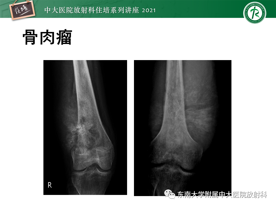 影像PPT - 【PPT】应力性骨折及与病理性骨折的鉴别诊断-48